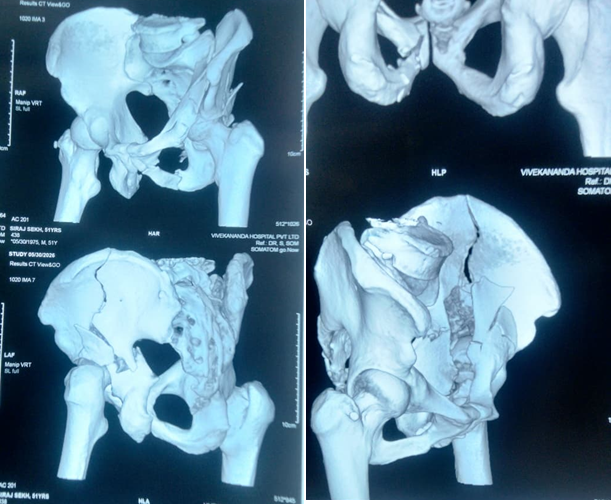 Preoperative 3D CT Reconstruction